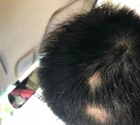 做梦头发掉秃一块什么意思（做梦头发掉秃了一块是什么预兆）